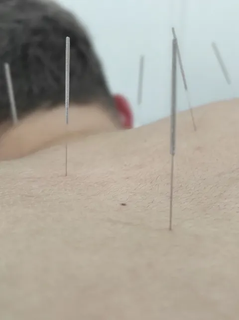 Acupuntura: fotografía principal