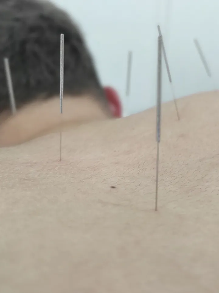 Acupuntura: fotografía principal