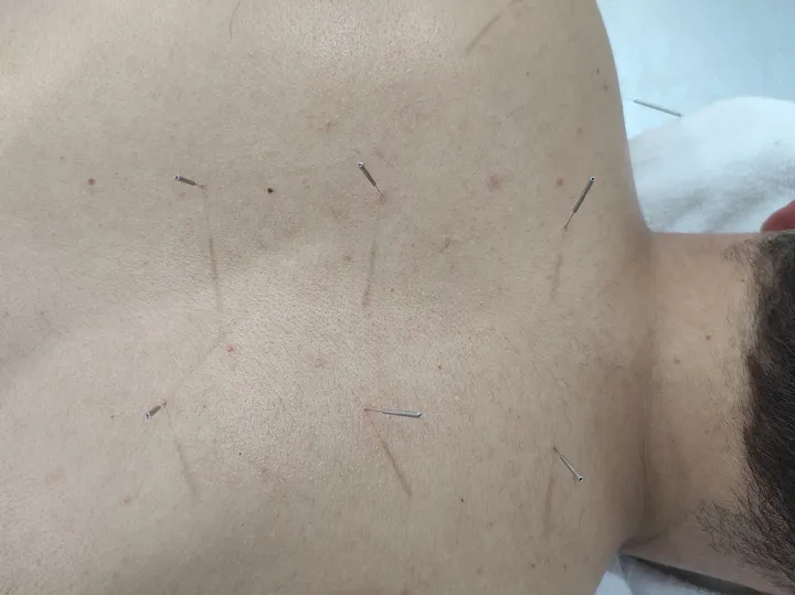 Acupuntura: fotografía 3 de 12