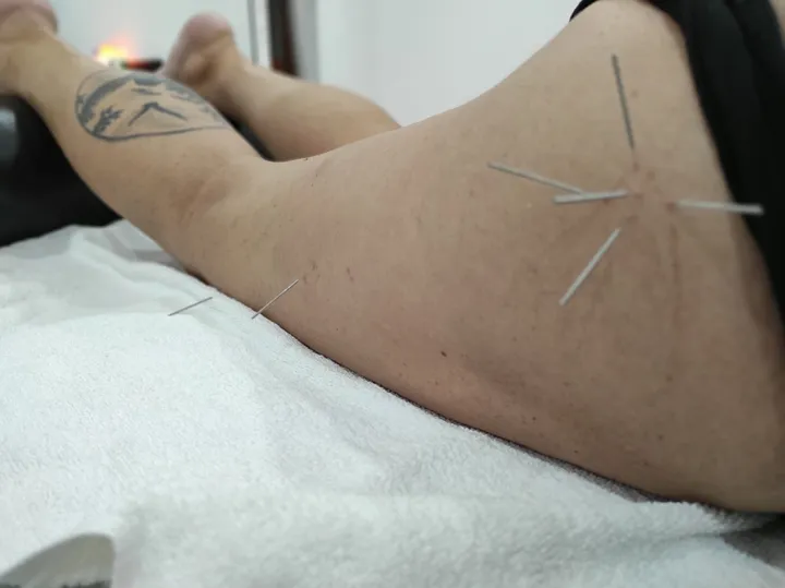 Acupuntura: fotografía 4 de 12