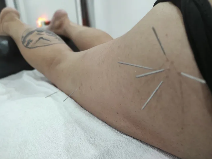 Acupuntura: fotografía 5 de 12