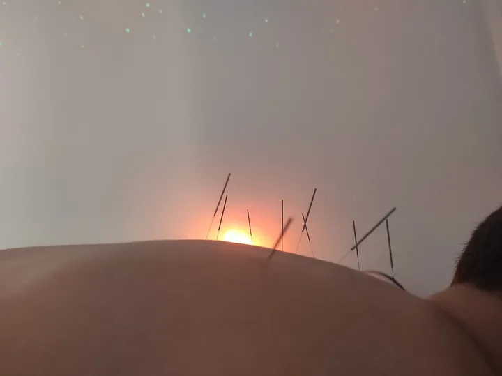 Acupuntura: fotografía 6 de 12