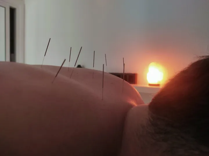 Acupuntura: fotografía 8 de 12