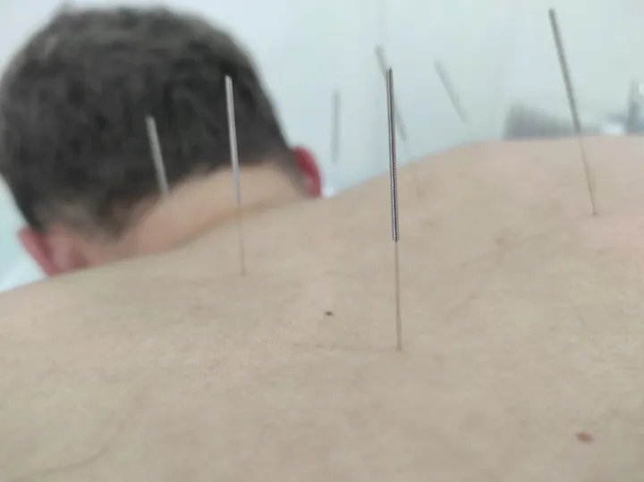 Acupuntura: fotografía 10 de 12
